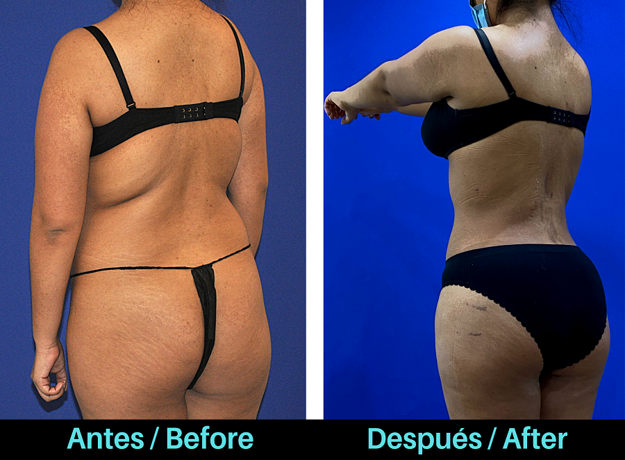 Foto que muestra el antes y el después del levantamiento de glúteos brasileño