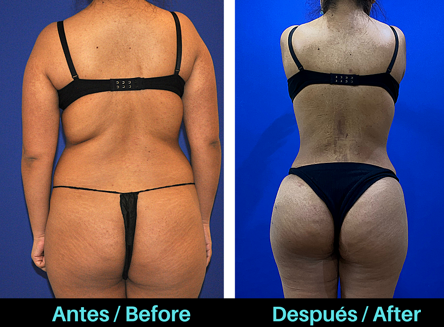Foto que muestra el antes y el después del levantamiento de glúteos brasileño