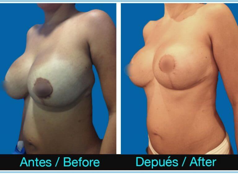 Gráfica que muestra el antes y después de la reducción mamaria