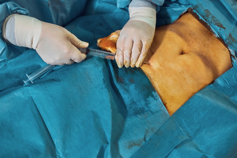 Liposucción: Técnicas Avanzadas y Resultados Duraderos