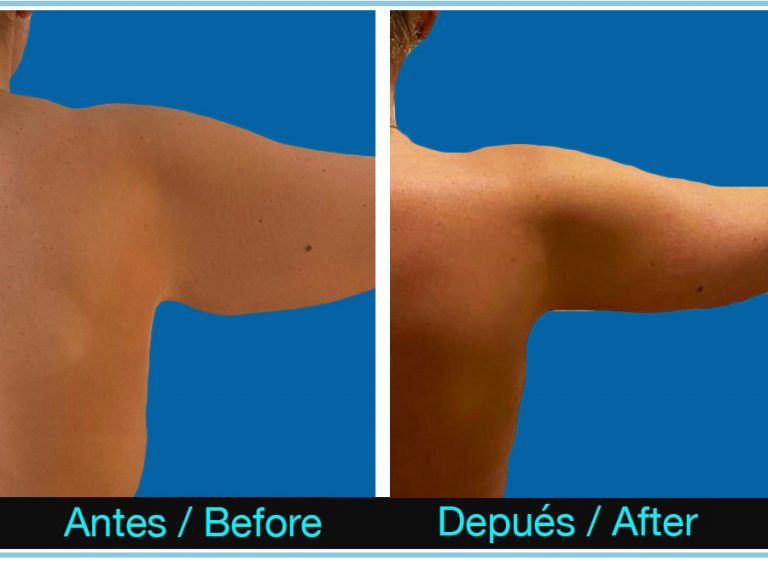 106_braquioplastia-768x561