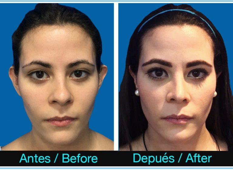 110_otoplastia-RINOPLASTIA-1-768x561