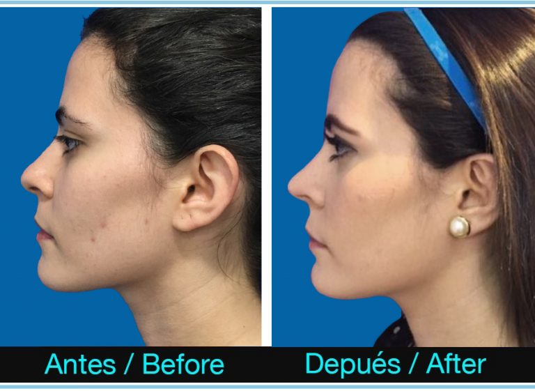 111_otoplastia-RINOPLASTIA-768x561