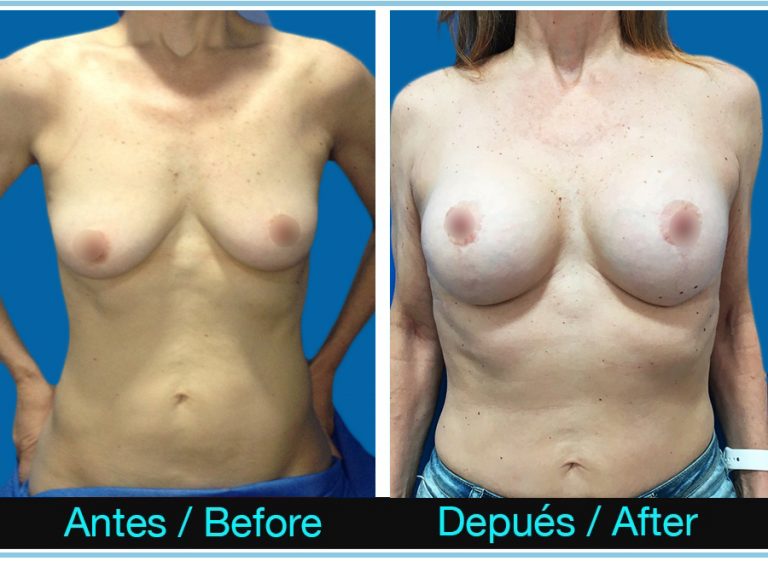 118_MASTOPEXIA-CON-PROTESIS-768x561