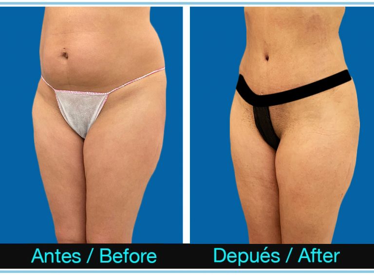 11_lipoVaser-1-768x566