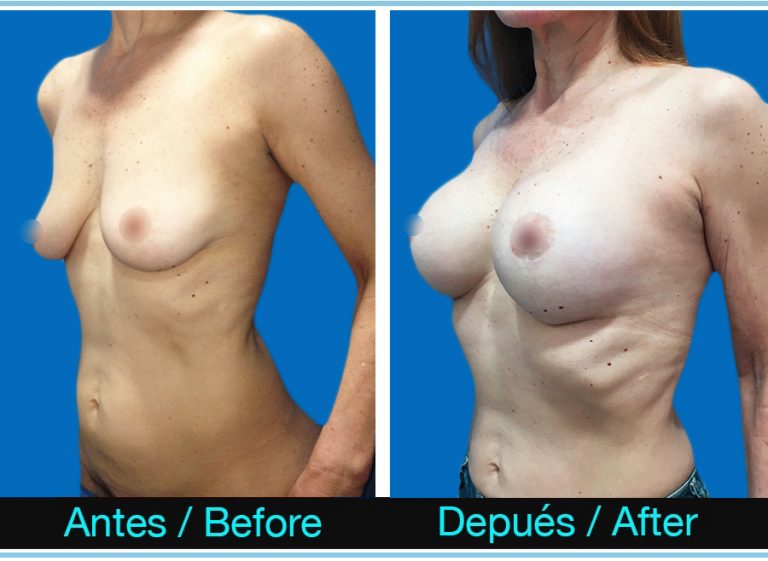 120_MASTOPEXIA-CON-PROTESIS-768x561