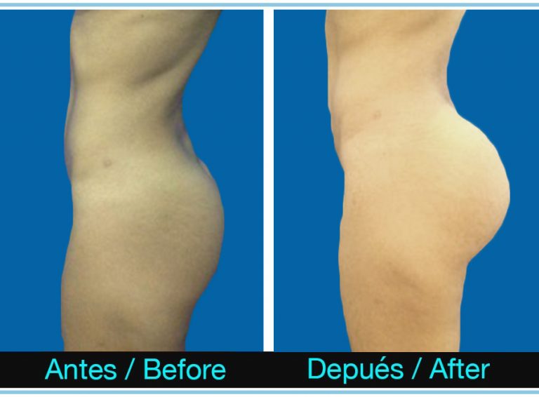 29_protesisGluteas-768x566