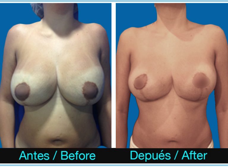 60_mamoplastia-de-reduccion-recambio-protesis-768x561