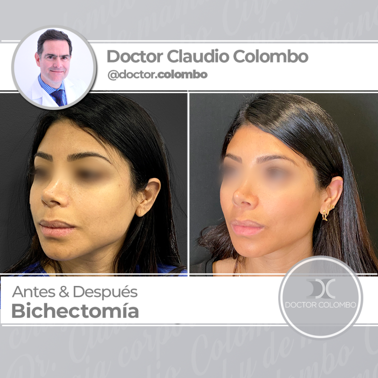 AD-4-COLOMBO-Bichectomia2-768x768