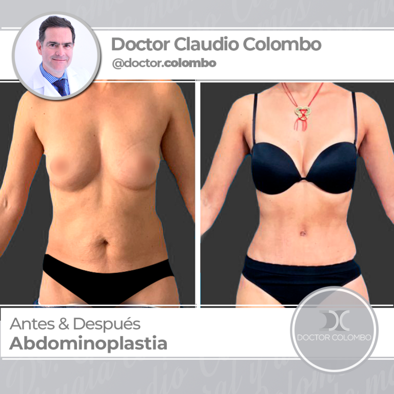 AD-COLOMBO-Abdominoplastia1-768x768