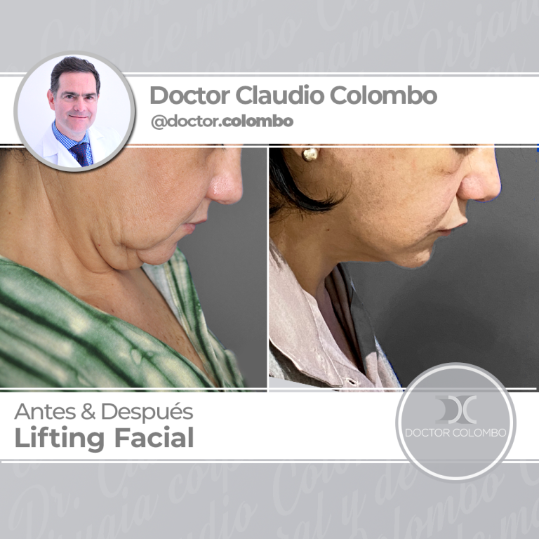 AD-COLOMBO-Lifting-Facial2-768x768