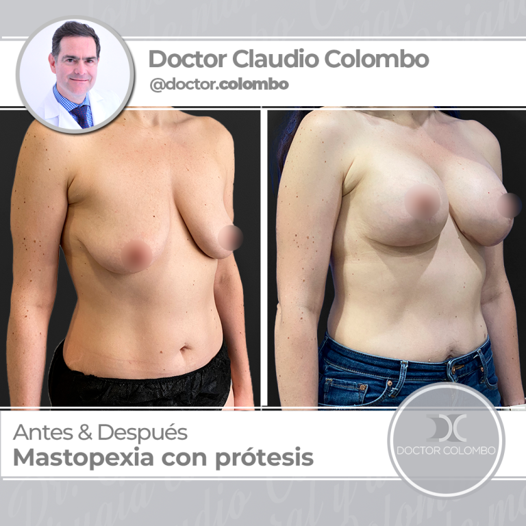 AD-COLOMBO-Mastopexia-con-Protesis2-768x768