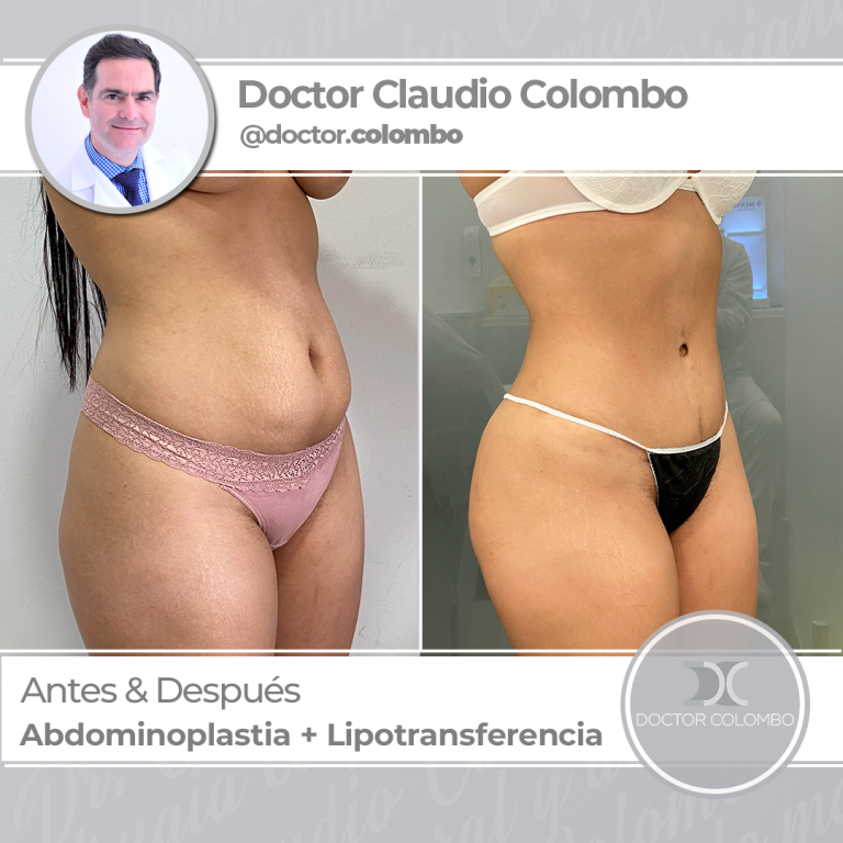 AD-COLOMBO-Nueva-Linea-AbdominoLipo1-2-768x768