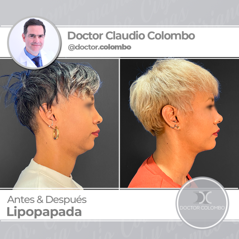 AD-COLOMBO-Nueva-Linea-Lipopapada-768x768