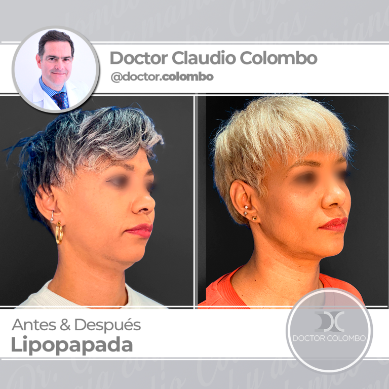 AD-COLOMBO-Nueva-Linea-Lipopapada_1-768x768