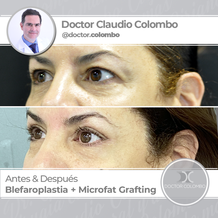 AD-COLOMBO-Nueva-Linea-O-Blefaroplastia-microfat2-1-768x768