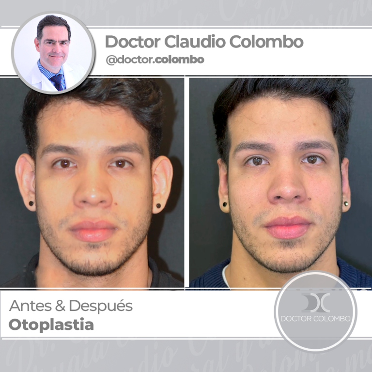 AD-COLOMBO-Otoplastia21-768x768