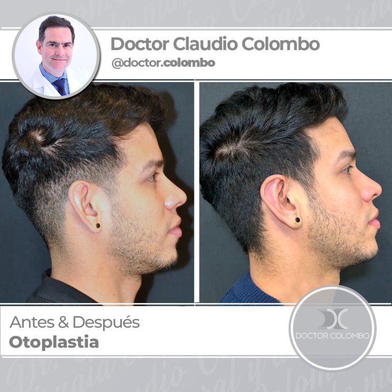AD-COLOMBO-Otoplastia22-1-768x768