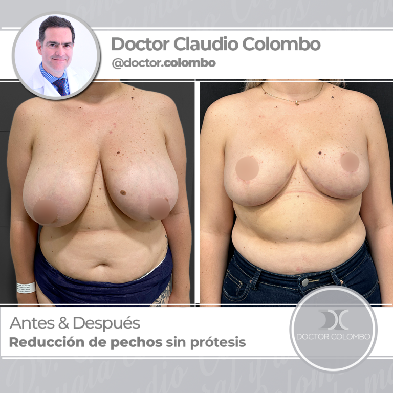 AD-COLOMBO-Reduccion-de-pechos-sin-protesis1-768x768