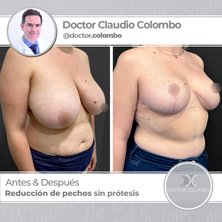 AD-COLOMBO-Reduccion-de-pechos-sin-protesis2-768x768