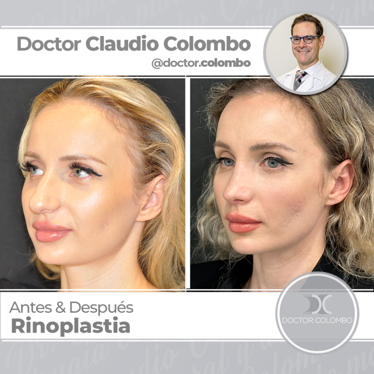 AD-COLOMBO-Rinoplastia32-768x768