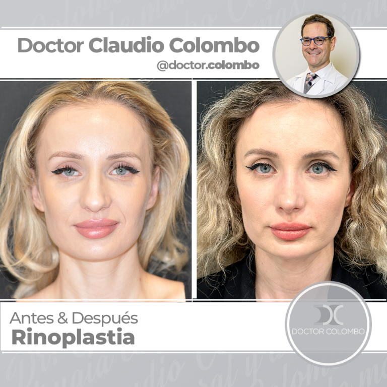 AD-COLOMBO-Rinoplastia33-768x768