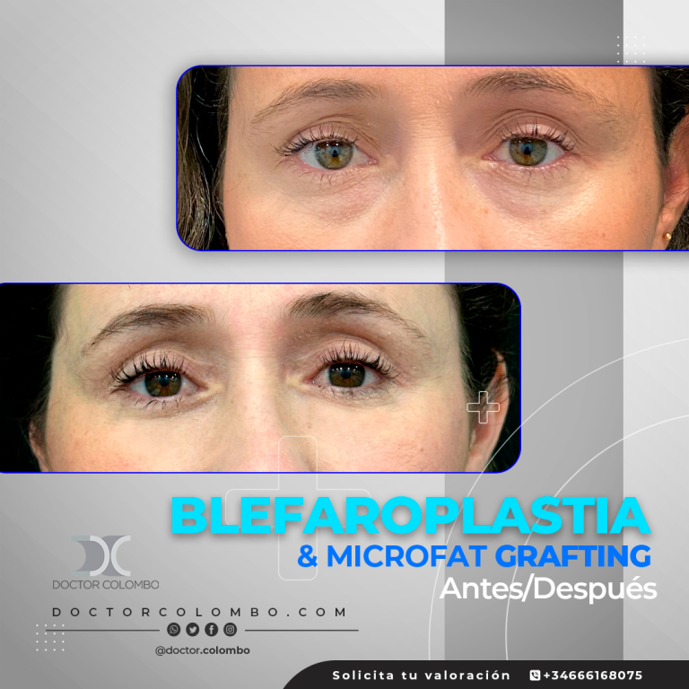 DR-COLOMBO-AD-2943-1-Blefaroplastia-768x768