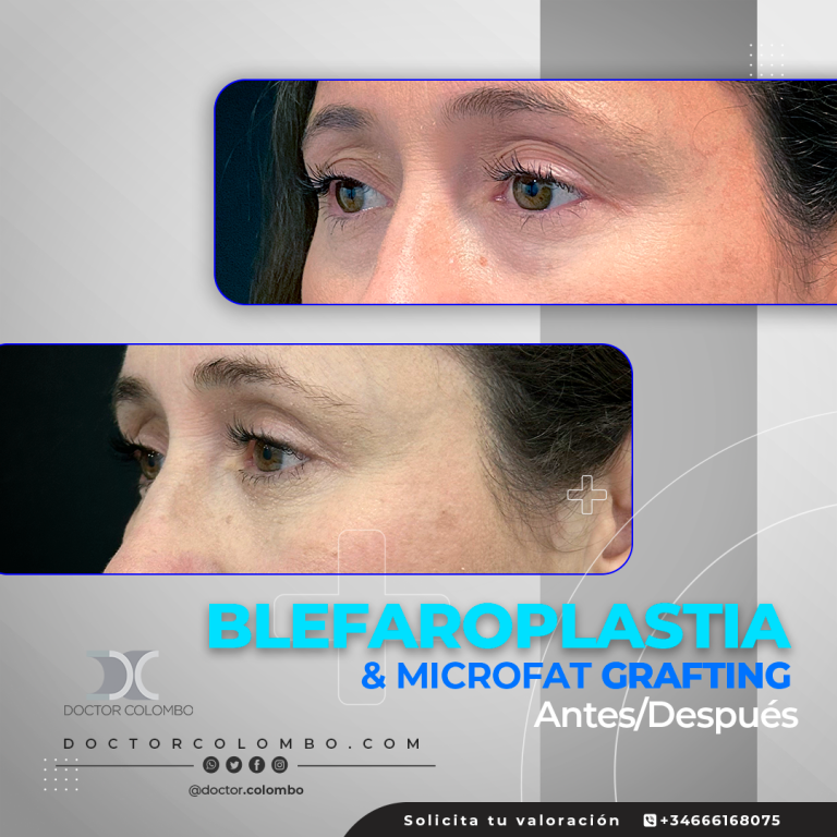 DR-COLOMBO-AD-2943-2-Blefaroplastia-768x768
