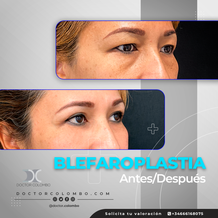 DR-COLOMBO-AD-3059-Blefaroplastia-3-1-768x768