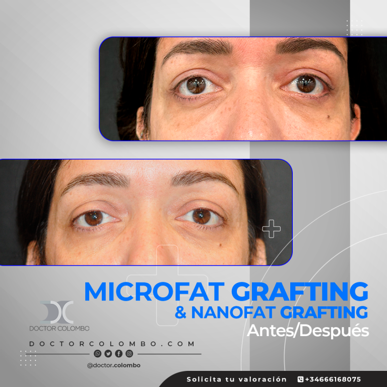 DR-COLOMBO-AD-Nanofat-Microfat-10461-768x768