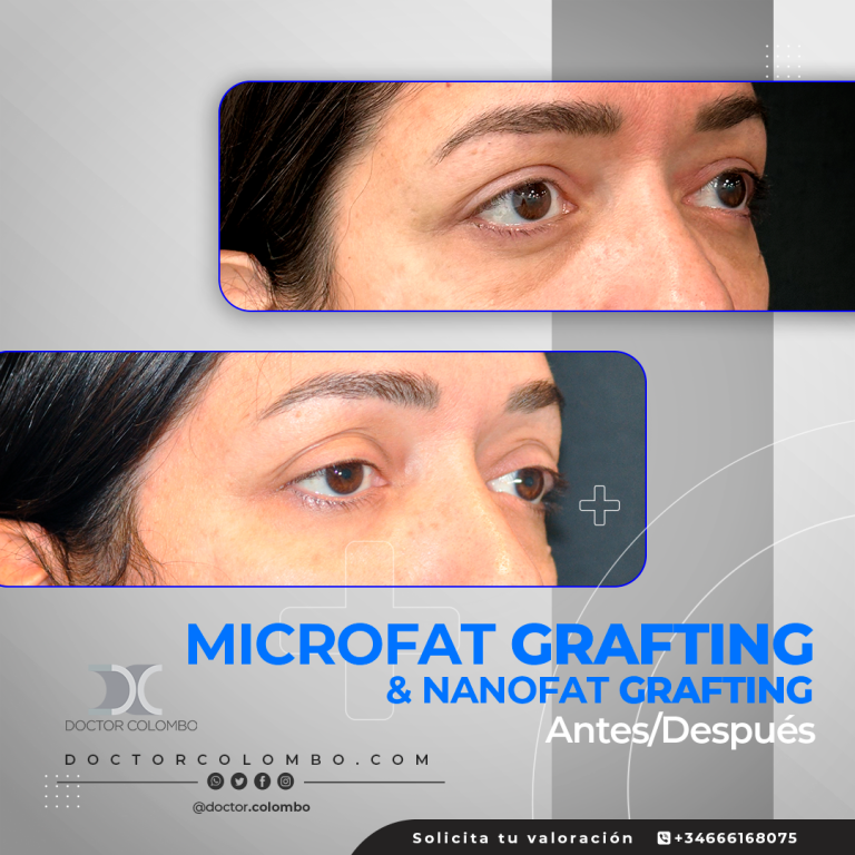 DR-COLOMBO-AD-Nanofat-Microfat-10462-768x768