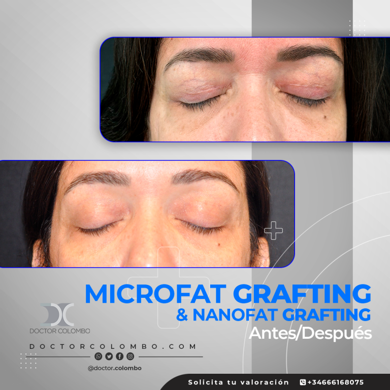 DR-COLOMBO-AD-Nanofat-Microfat-10463-768x768