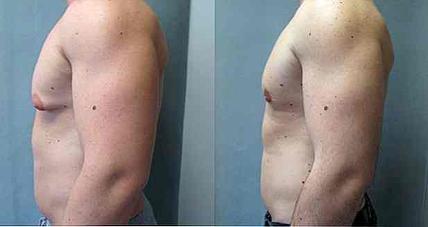 ginecomastia-precio-en-madrid