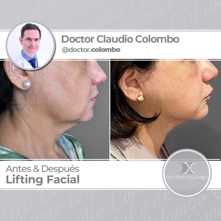 Lifting de cuello en Madrid