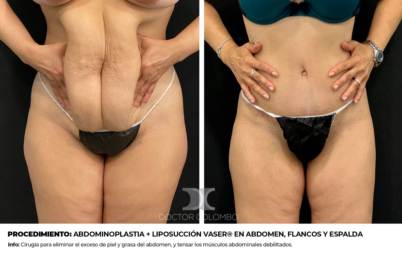 Abdominoplastia - antes y después, vista posterior