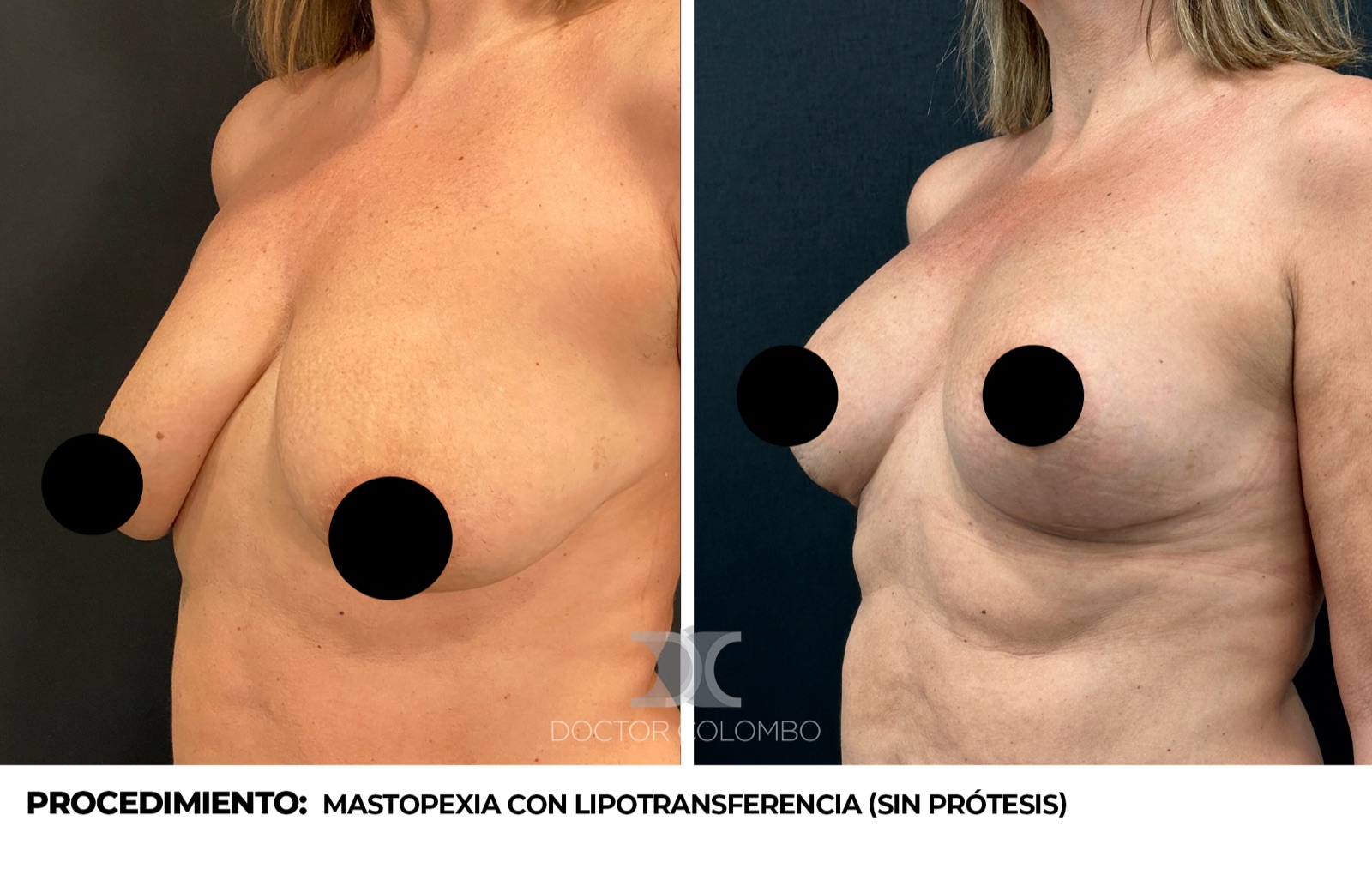 Antes y después corrección de asimetría mamaria - Dr. Colombo, vista de perfil