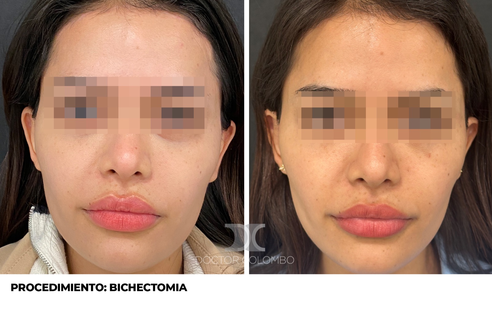 Resultado de bichectomía - antes y después, vista frontal
