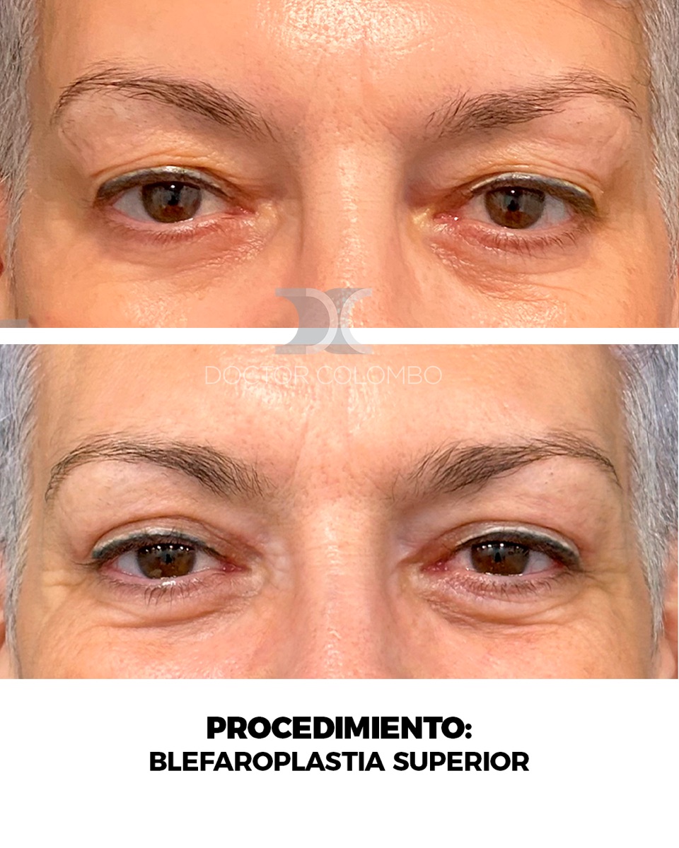 Antes y despues Blefaroplastia Superior