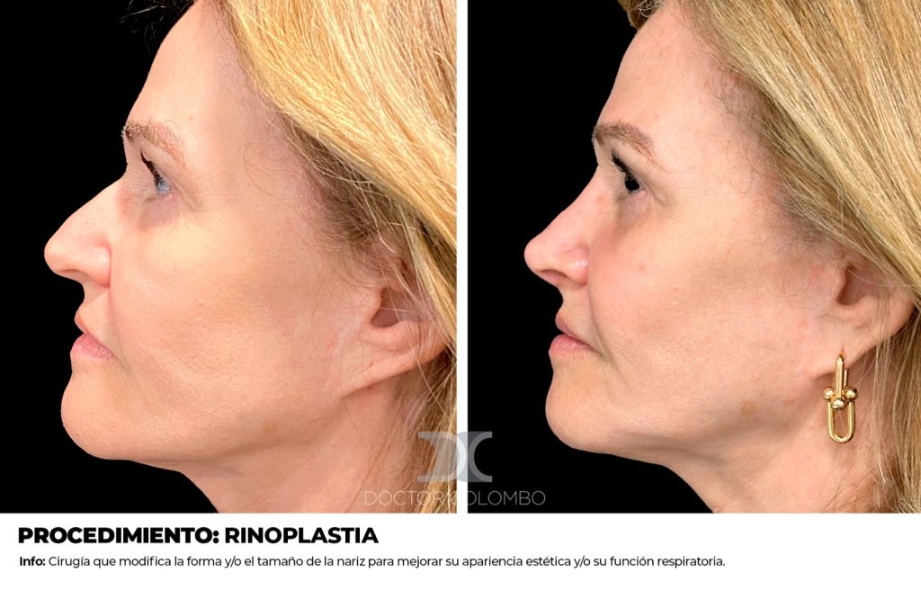 MASTOPEXIA EN T INVERTIDA + RECAMBIO DE PROTESIS + LIPOSUCCIÓN VASER® DE BORDE DE PECTORAL + REDUCCION DE PEZONES – SIN NOCHE DE HOSPITALIZACIÓN — 2641 — Perfil izquierdo