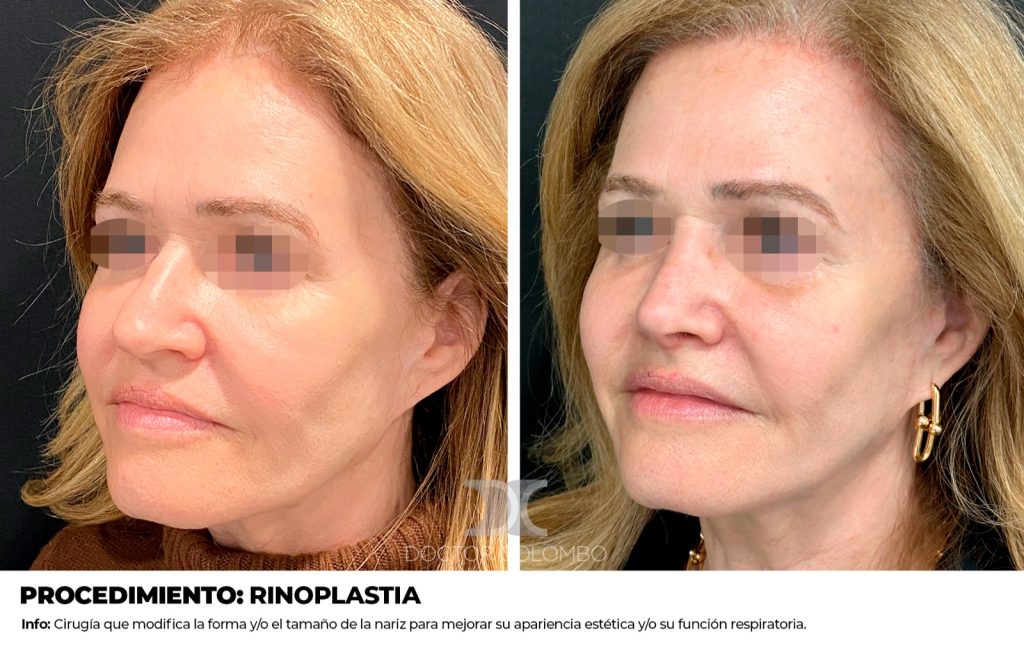 RINOPLASTIA — 2641 — Vista 1