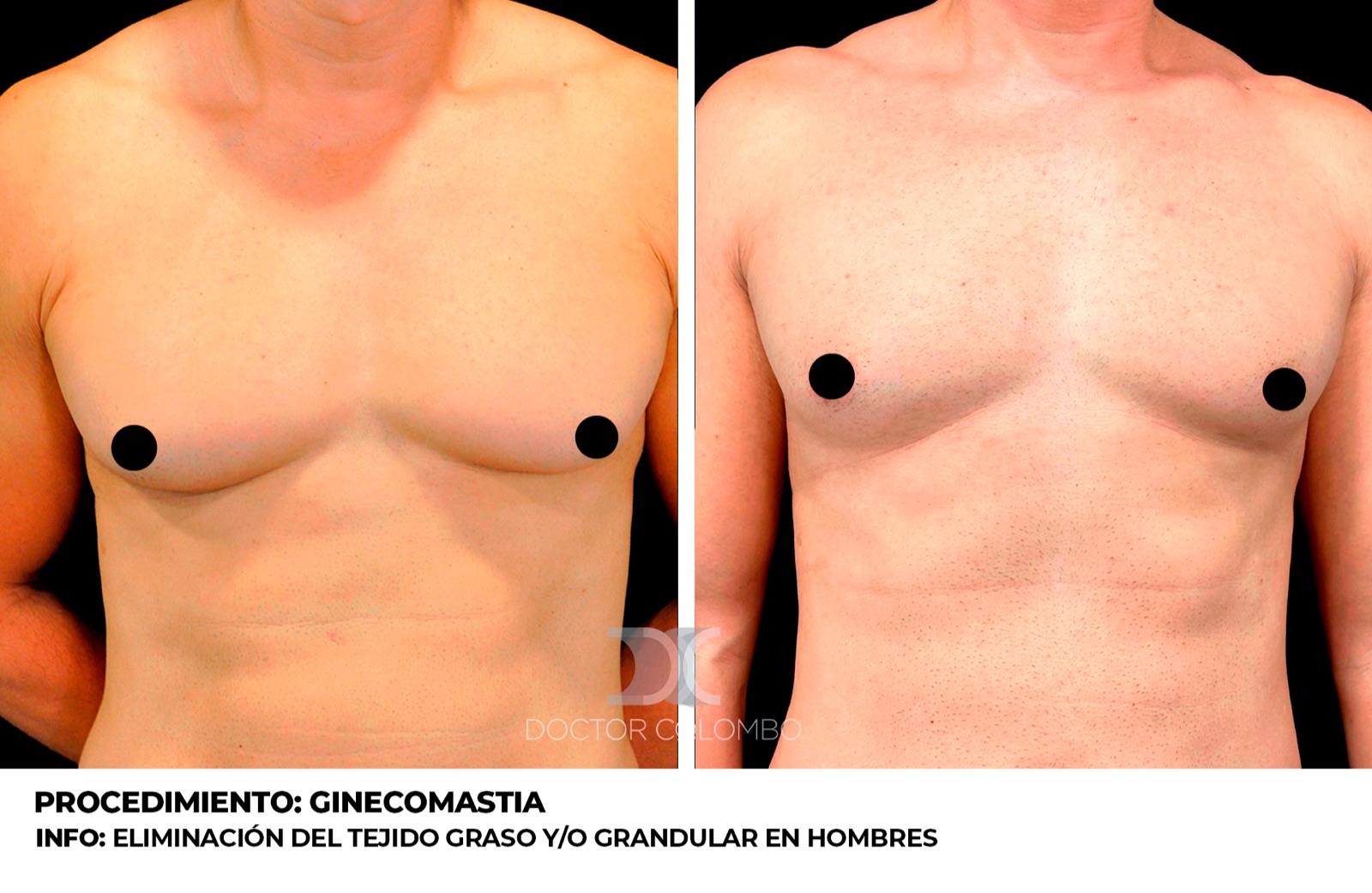 Resultado de cirugía de ginecomastia - antes y después, vista frontal