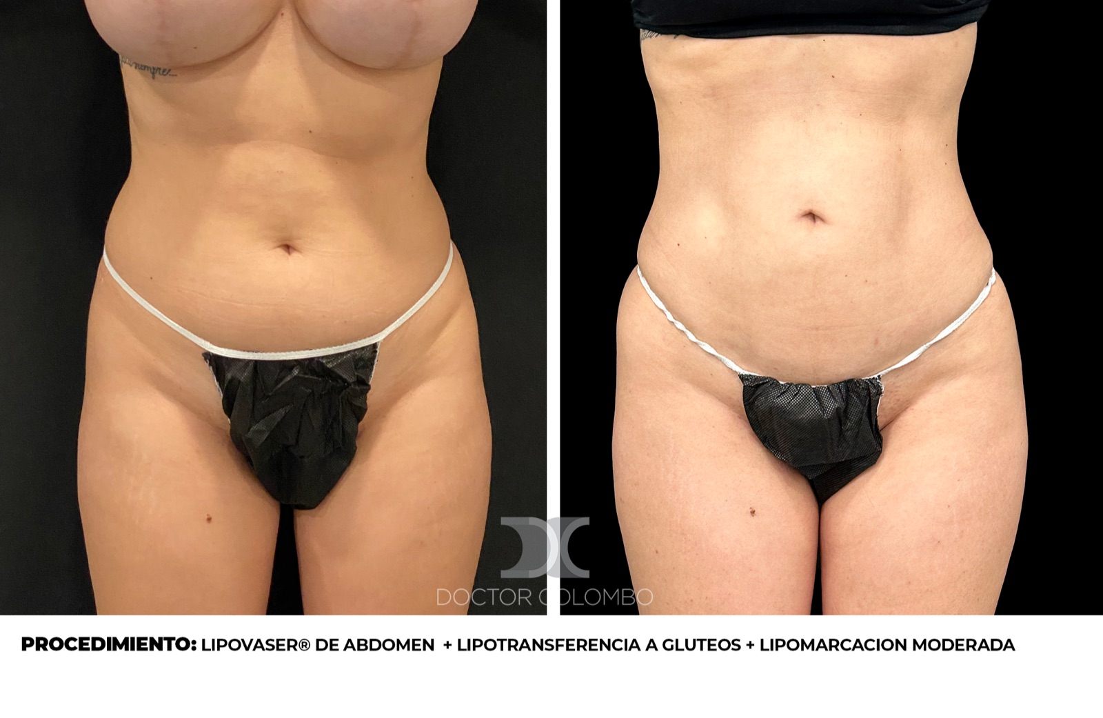 Antes y despu&eacute;s lipomarcaci&oacute;n HD - Dr. Colombo Madrid