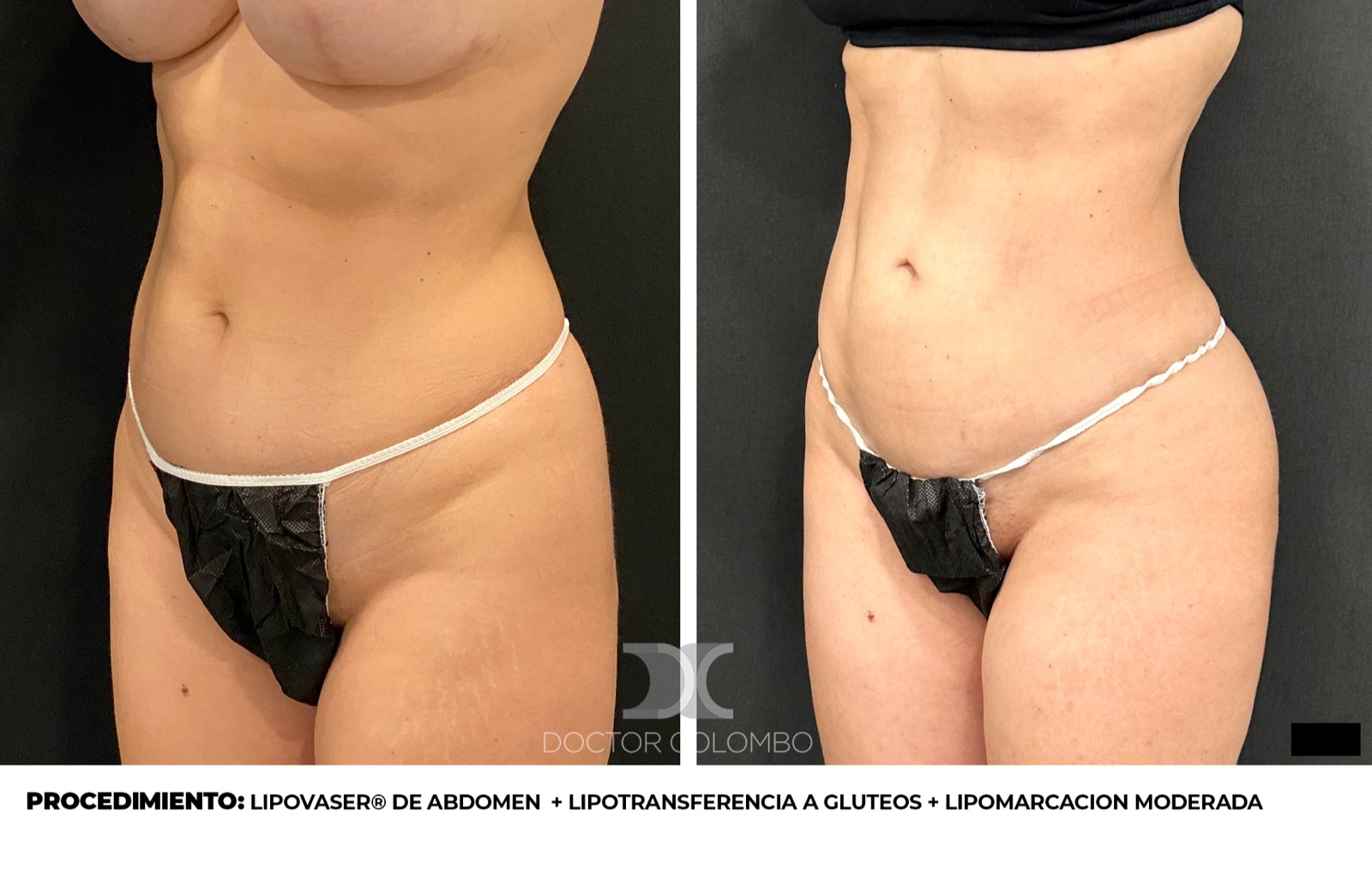 Resultado lipomarcaci&oacute;n HD - Dr. Colombo Madrid