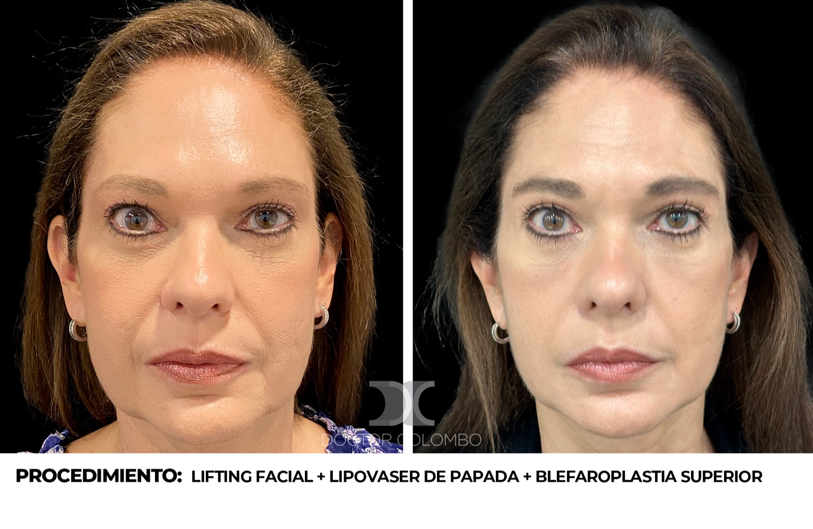 Antes y despues Lifting Deep Plane