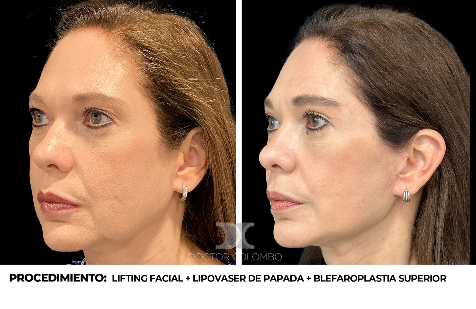 Lifting facial - antes y después, vista de perfil
