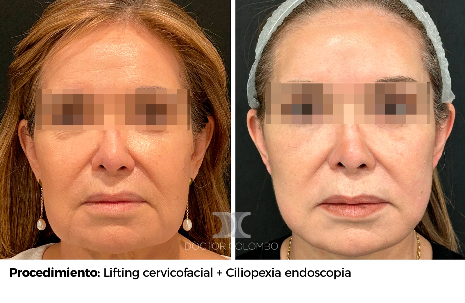 Resultado de lifting facial - antes y después, vista frontal