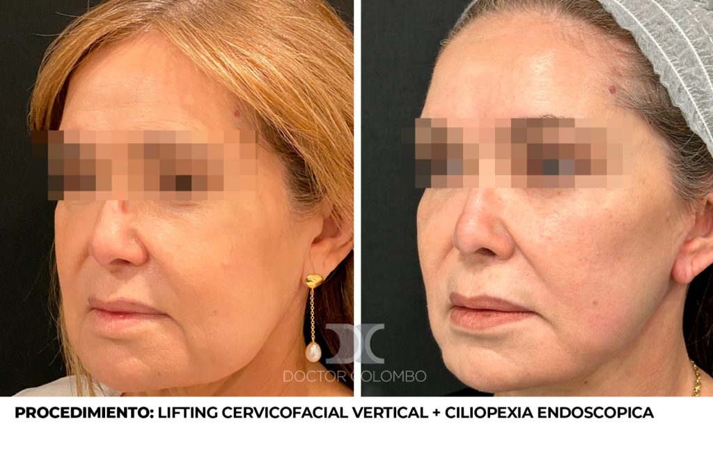 LIFTING CERVICOFACIAL VERTICAL + CILIOPEXIA ENDOSCOPICA — 4626 — Perfil derecho