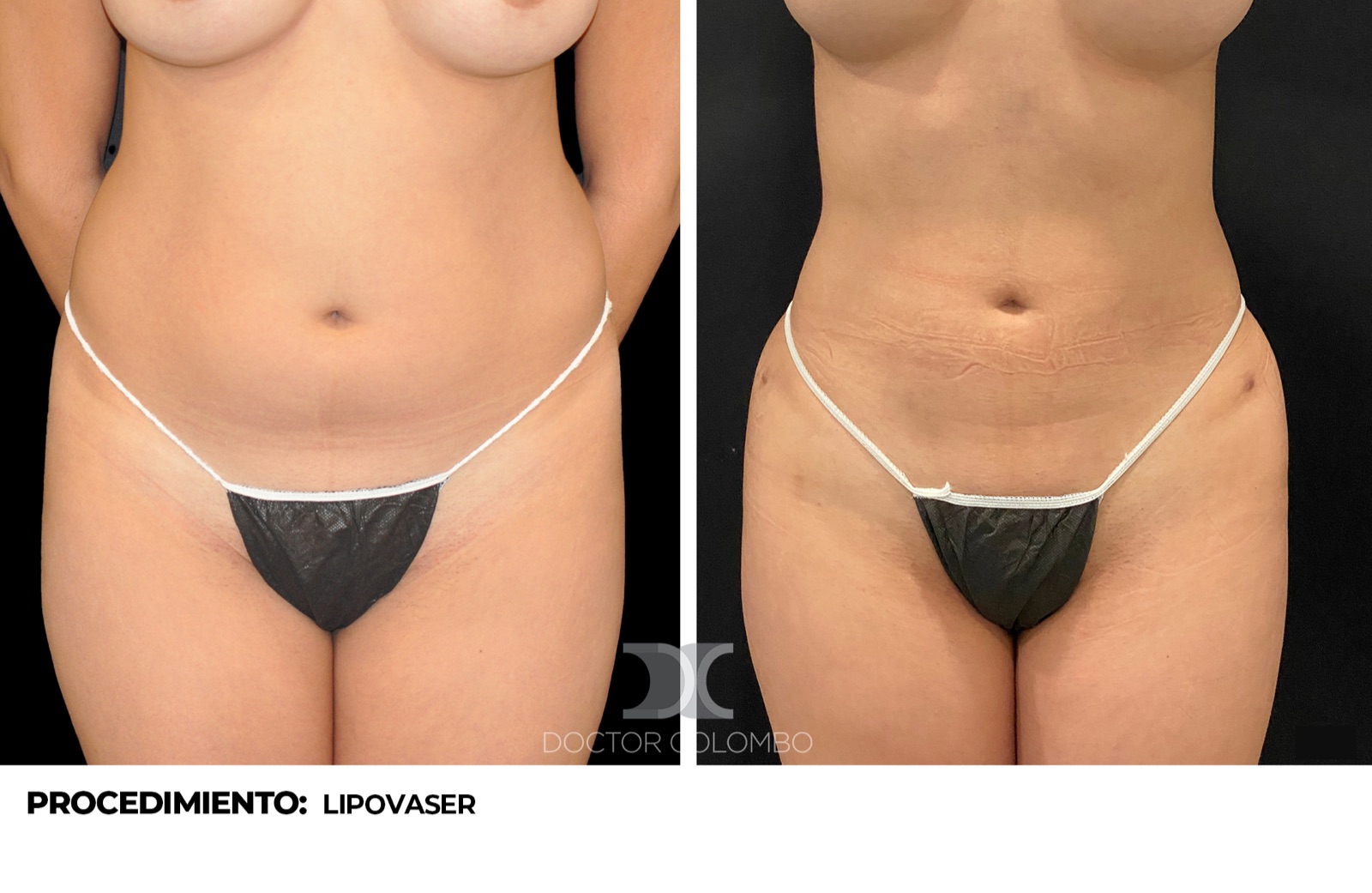 Antes y despues Liposuccion VASER