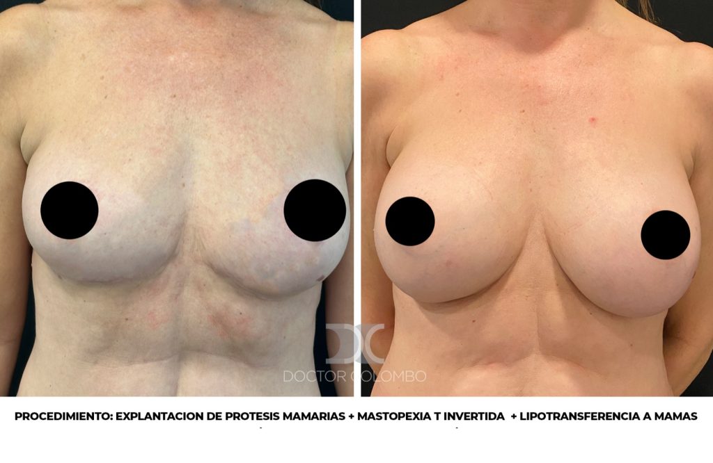 EXPLANTACION DE PROTESIS MAMARIAS + MASTOPEXIA T INVERTIDA  + LIPOTRANSFERENCIA A MAMAS — Perfil izquierdo