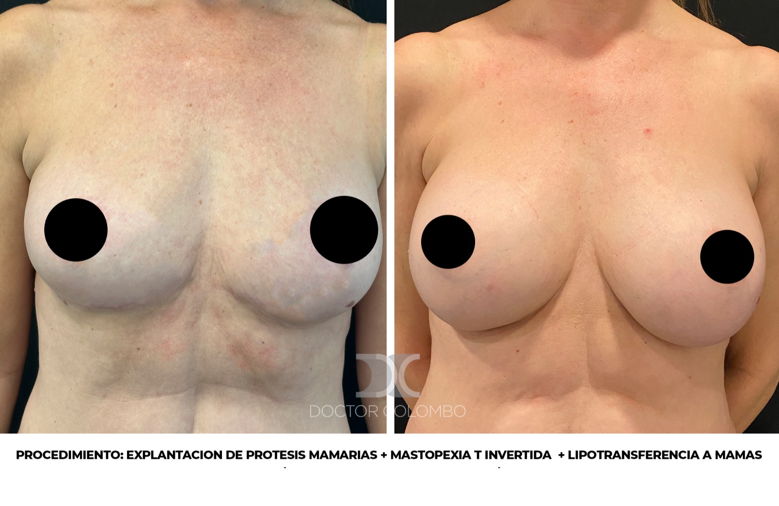 Antes y despues Lipotransferencia Mamaria